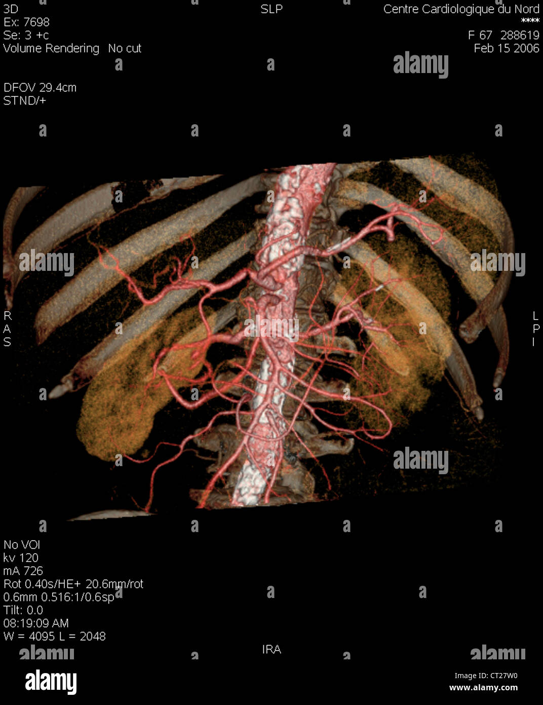 KIDNEY ARTERY, 3D SCAN Stock Photo