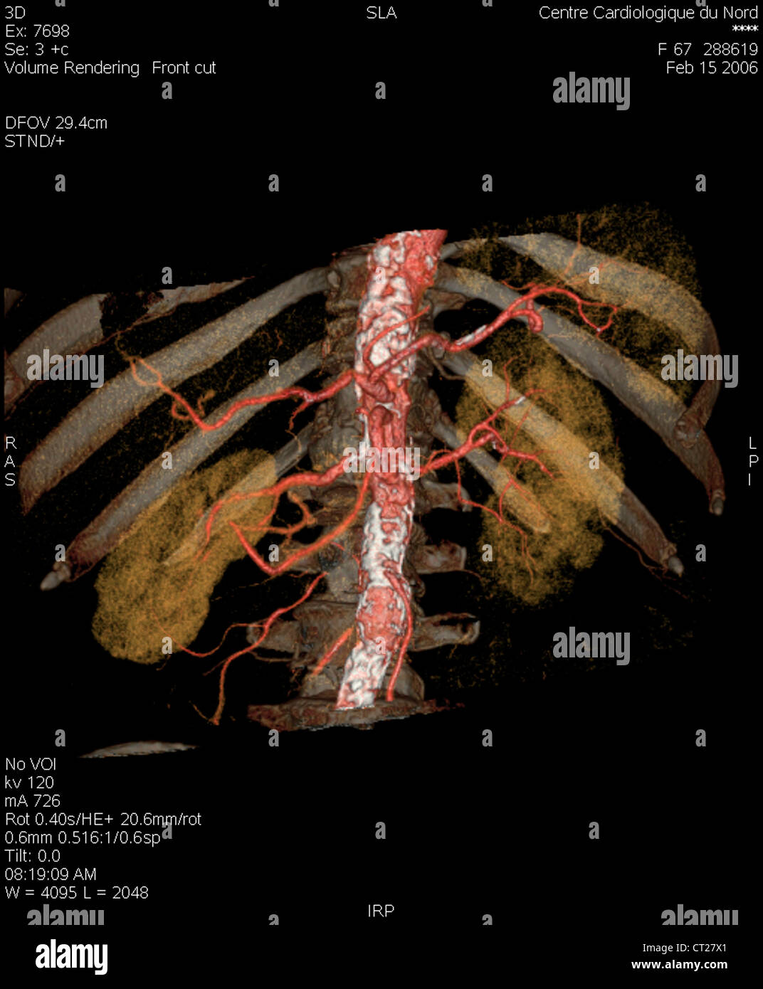 KIDNEY ARTERY, 3D SCAN Stock Photo Alamy