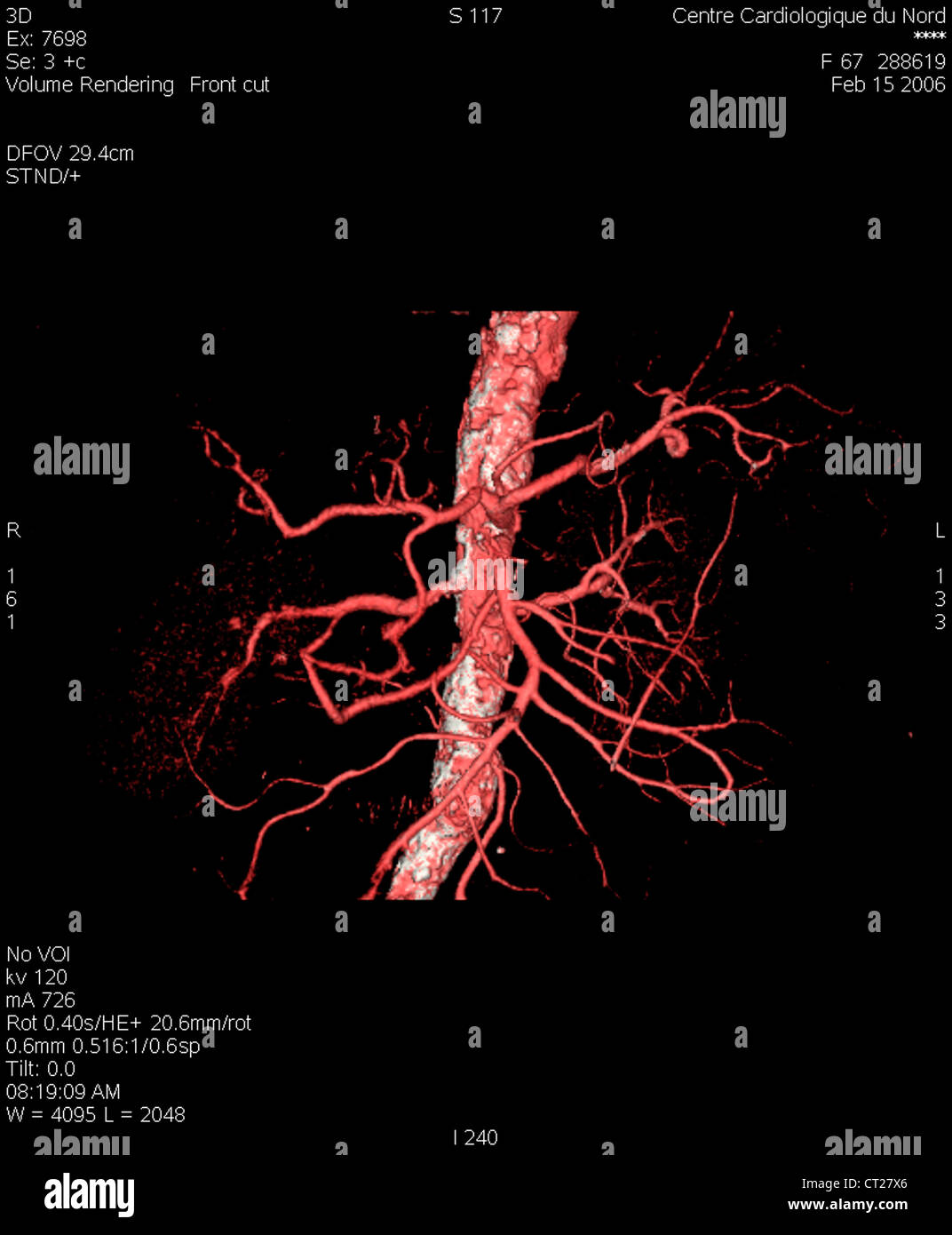 AORTA, 3D SCAN Stock Photo