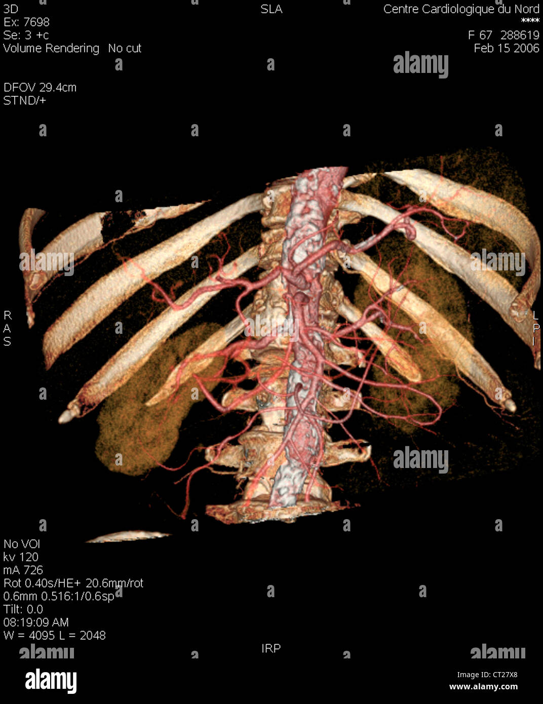 KIDNEY ARTERY, 3D SCAN Stock Photo