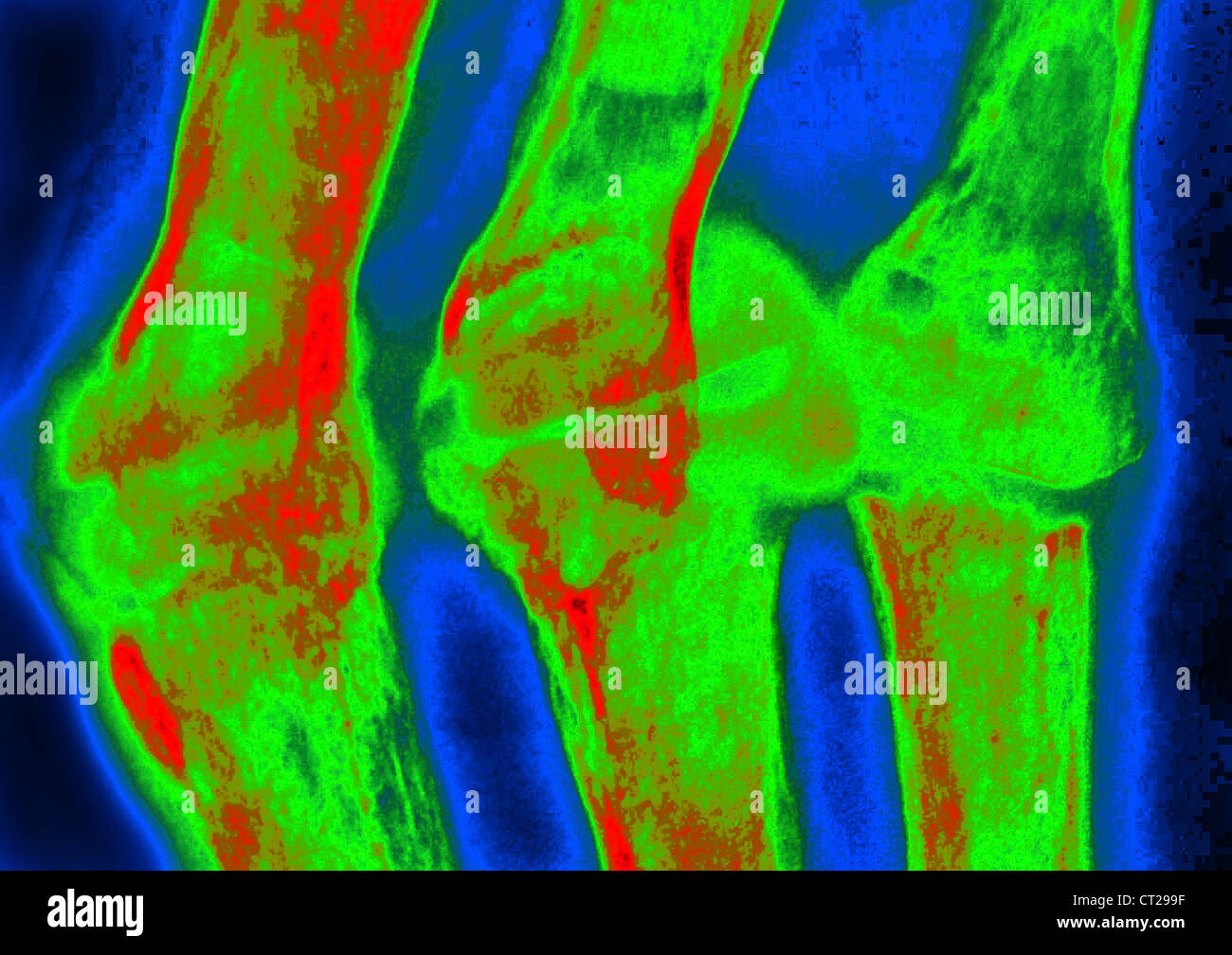 RHEUMATOID ARTHRITIS, XRAY Stock Photo Alamy