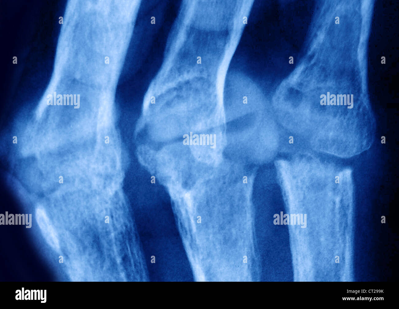 RHEUMATOID ARTHRITIS, XRAY Stock Photo Alamy