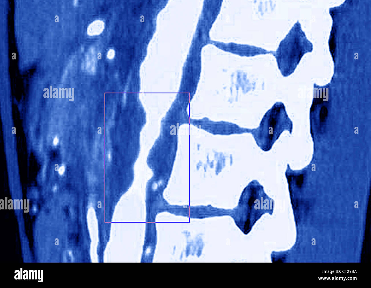 TAKAYASU'S ARTERITIS, MRI Stock Photo