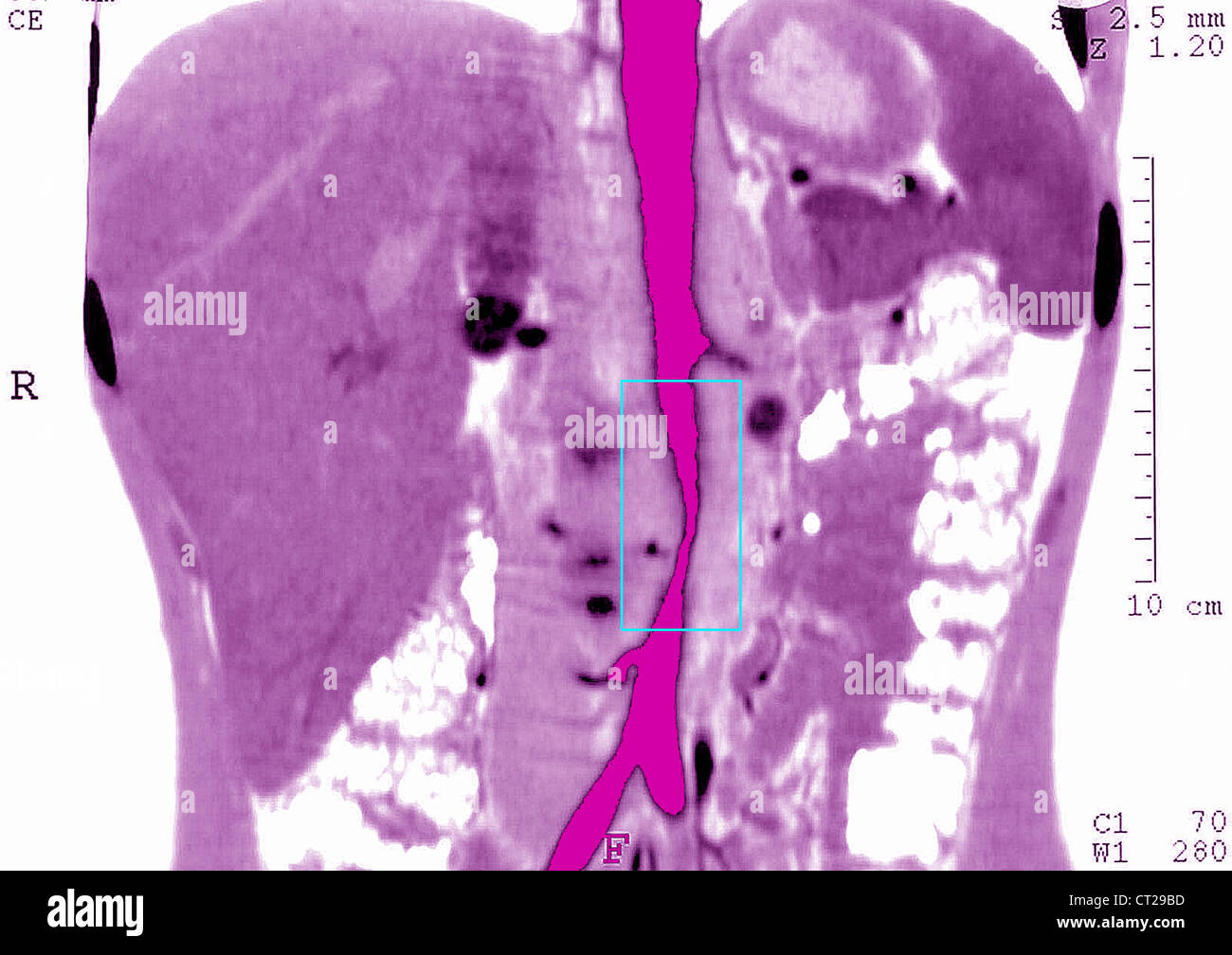 TAKAYASU'S ARTERITIS, MRI Stock Photo - Alamy