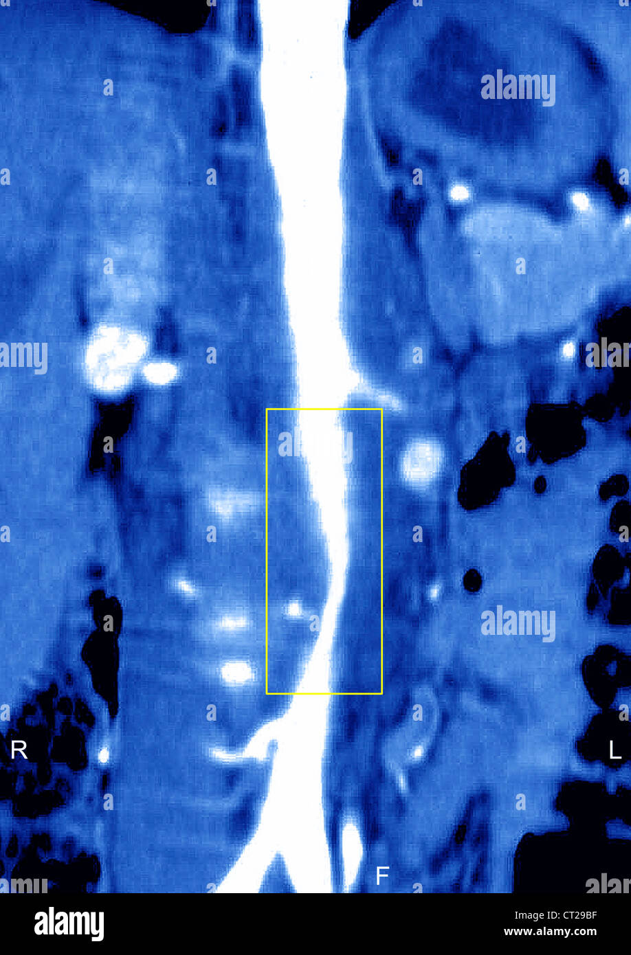 TAKAYASU'S ARTERITIS, MRI Stock Photo