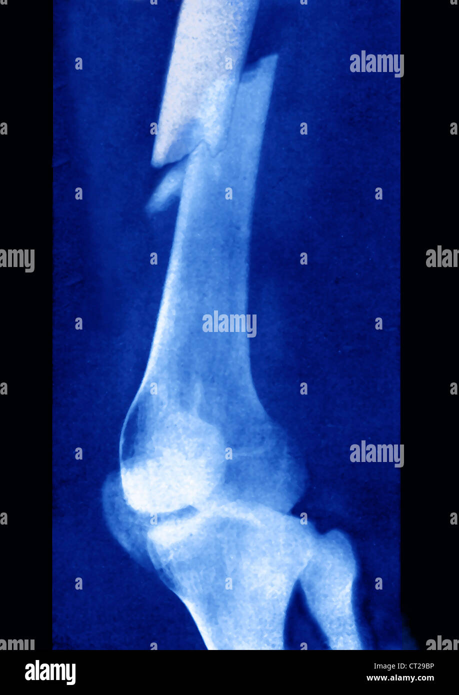 FRACTURED FEMUR, XRAY Stock Photo Alamy