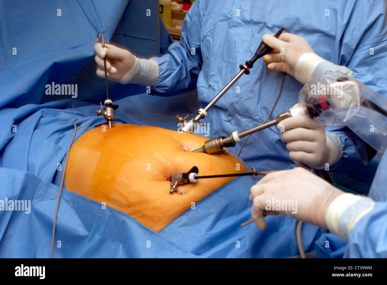 GALLBLADDER REMOVAL Stock Photo - Alamy