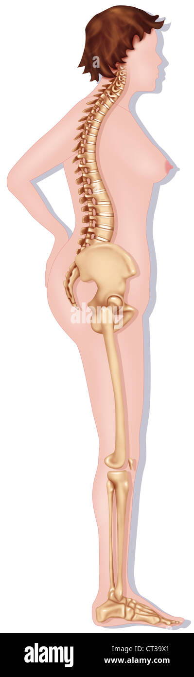 COMPRESSION FRACTURE, DRAWING Stock Photo