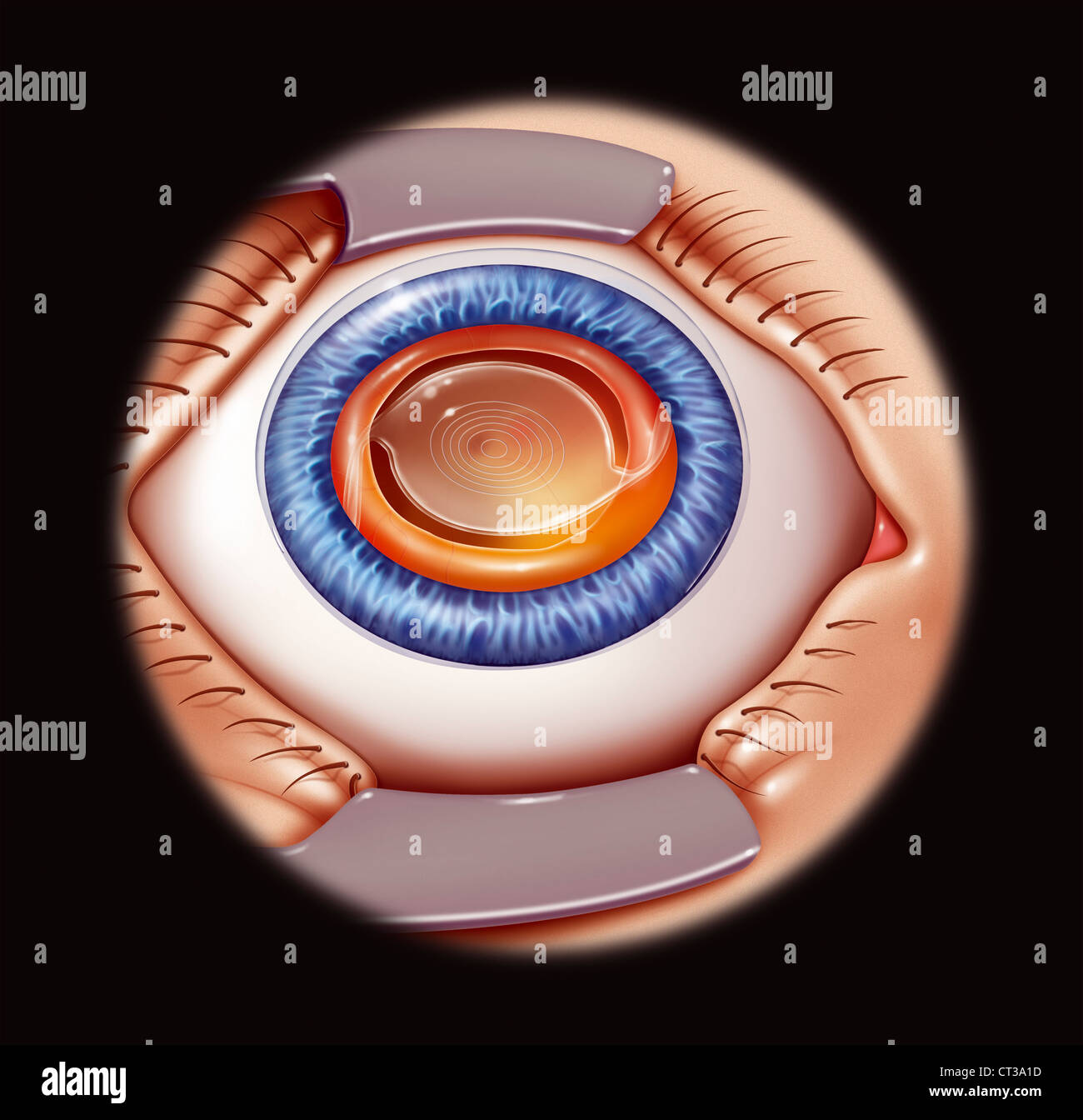 Posterior chamber intraocular lenses hires stock photography and