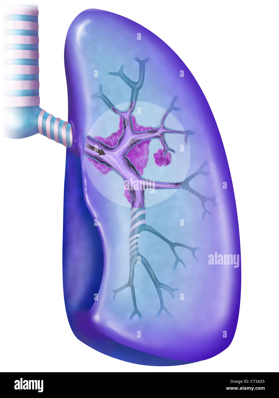 Lung cancer drawing hi-res stock photography and images - Alamy