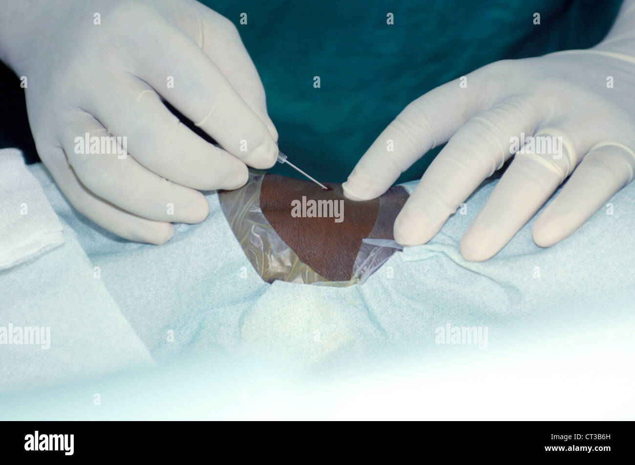 The cardiologist again flushes a saline solution through the catheter. Note the characteristic