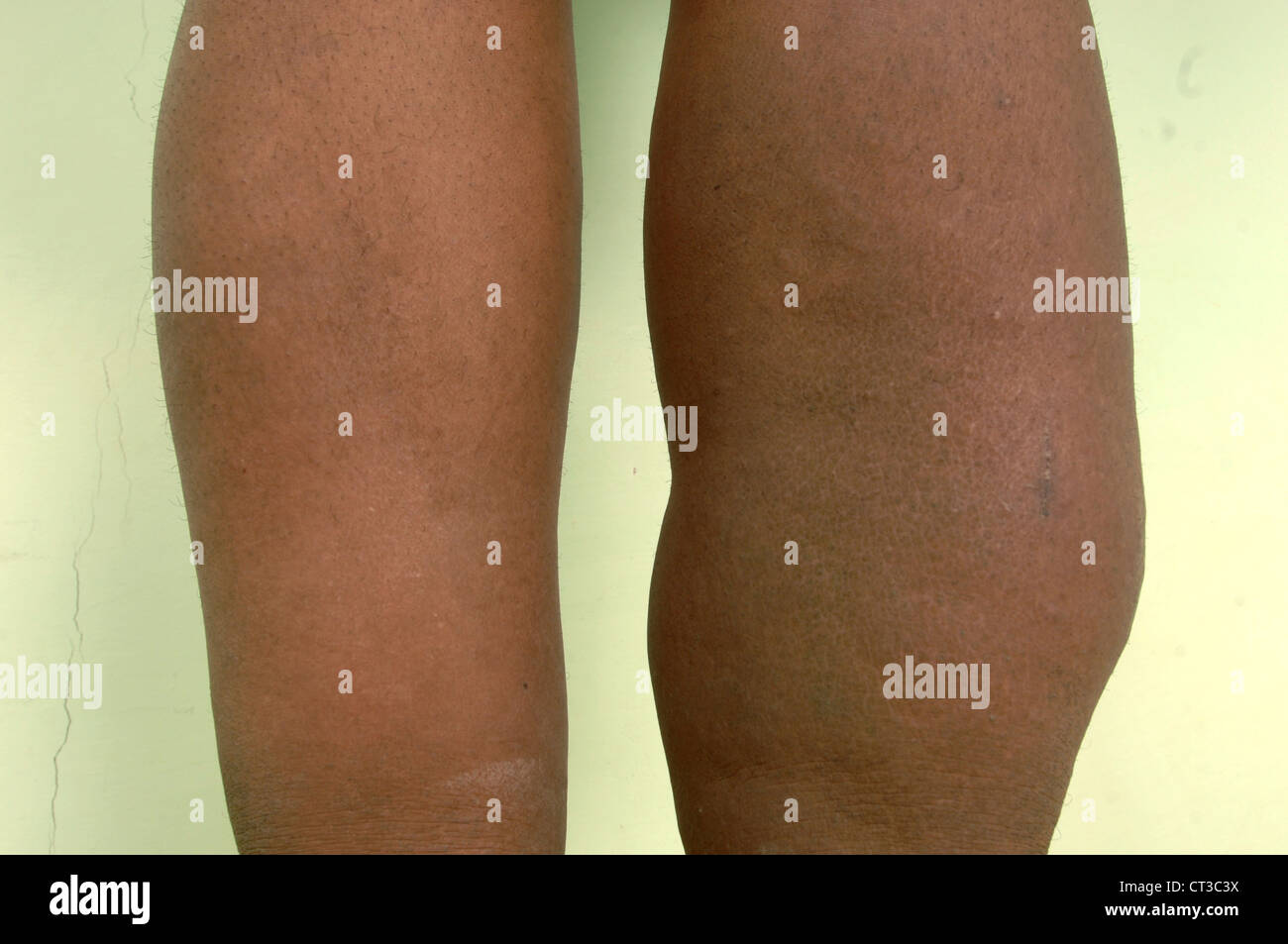 Congenital Diseases Edema Fluid Legs Stock Photo
