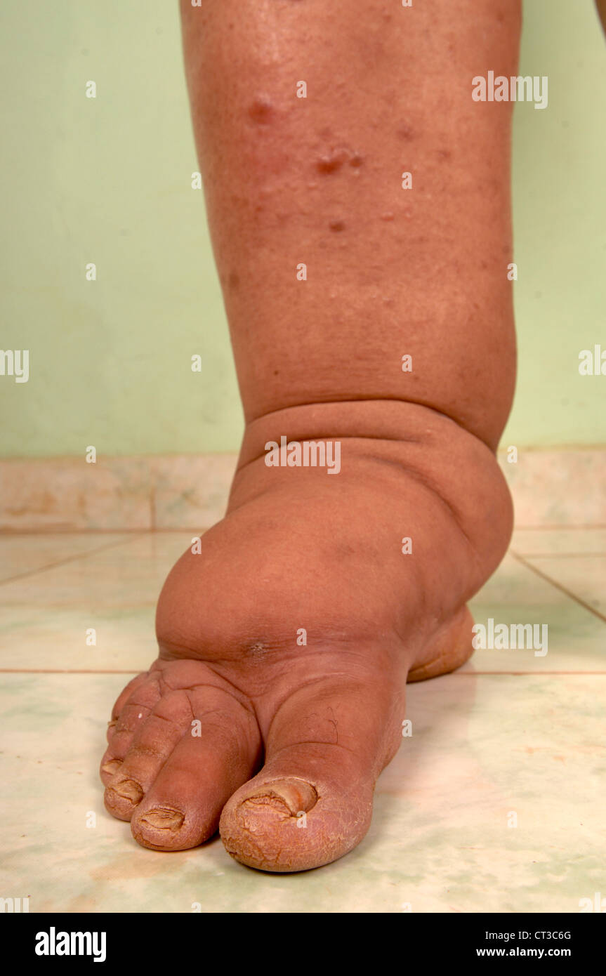 Congenital Diseases Edema Feet Stock Photo