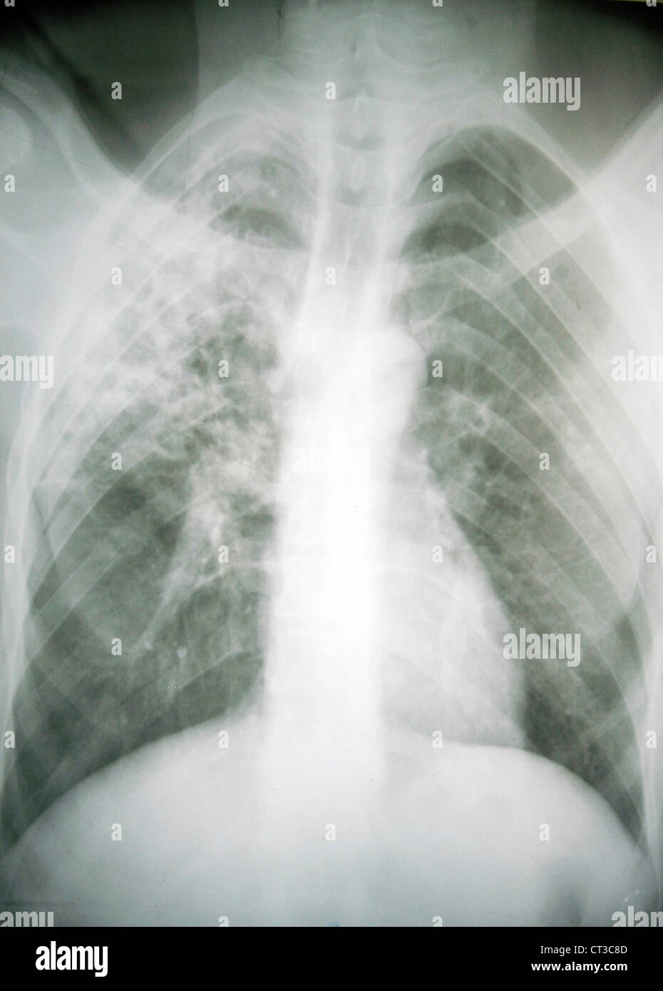 x-ray of rib cage Stock Photo