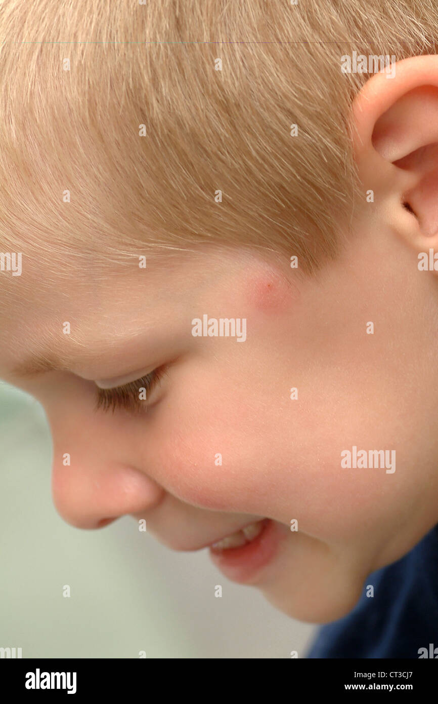 Insect bite face hi-res stock photography and images - Alamy