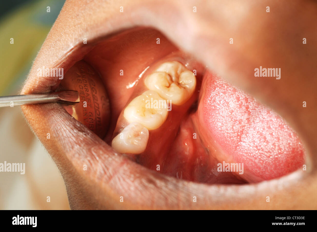 A dentist checking the teeth of a young female patient, showing slight decay. Stock Photo
