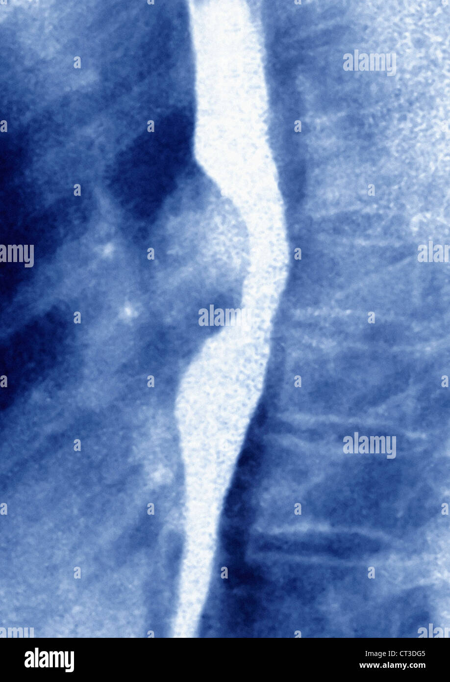 ESOPHAGEAL LEIOMYOMA, XRAY Stock Photo Alamy