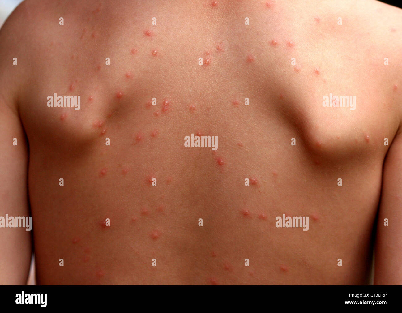 CHICKENPOX Stock Photo - Alamy CHICKENPOX Stock Photo - Alamy