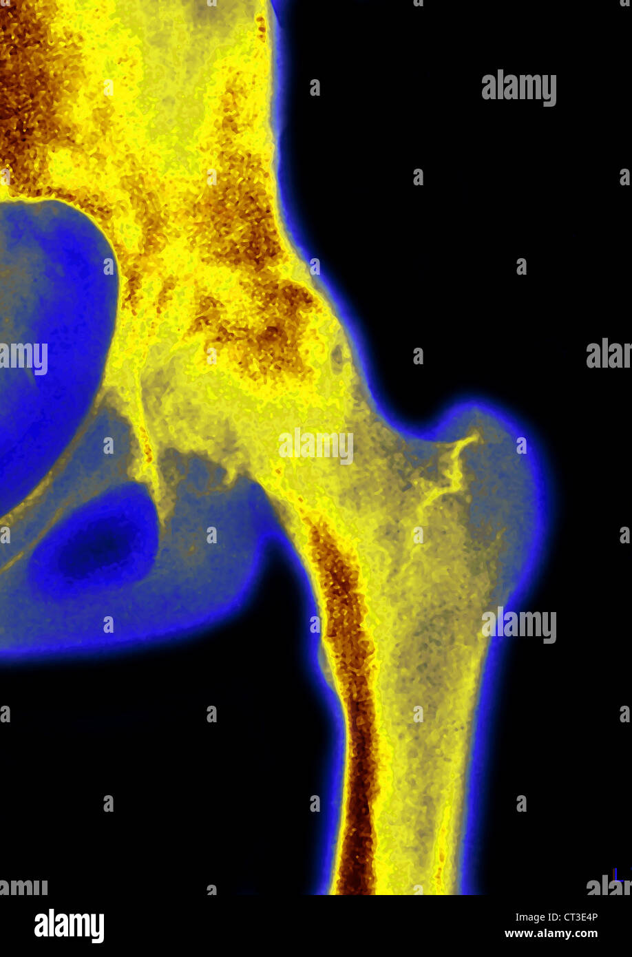 HIP OSTEOARTHRITIS, XRAY Stock Photo Alamy