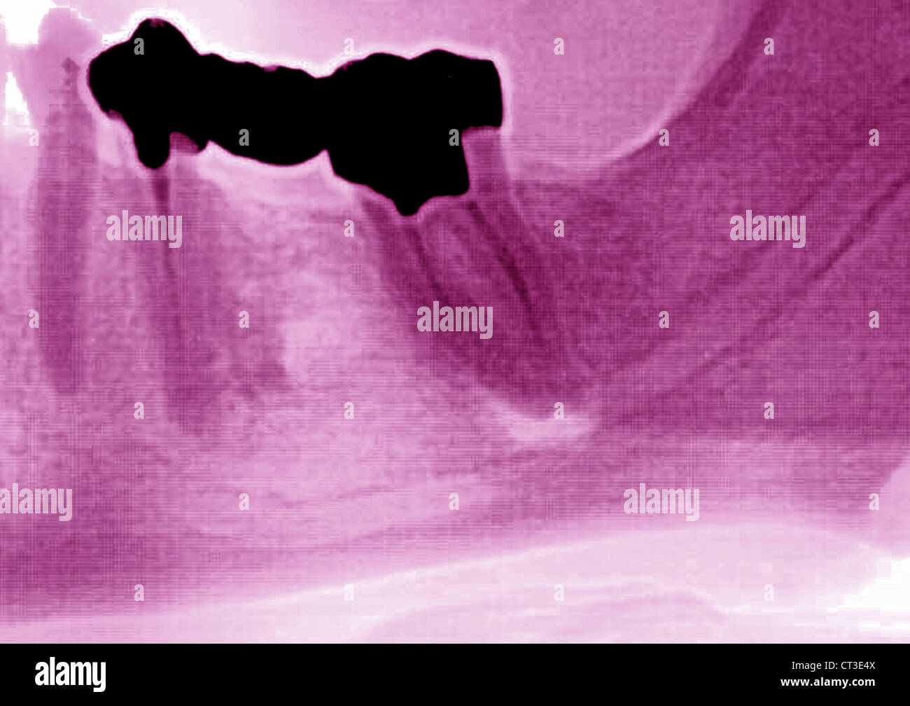 Cavity teeth x ray hires stock