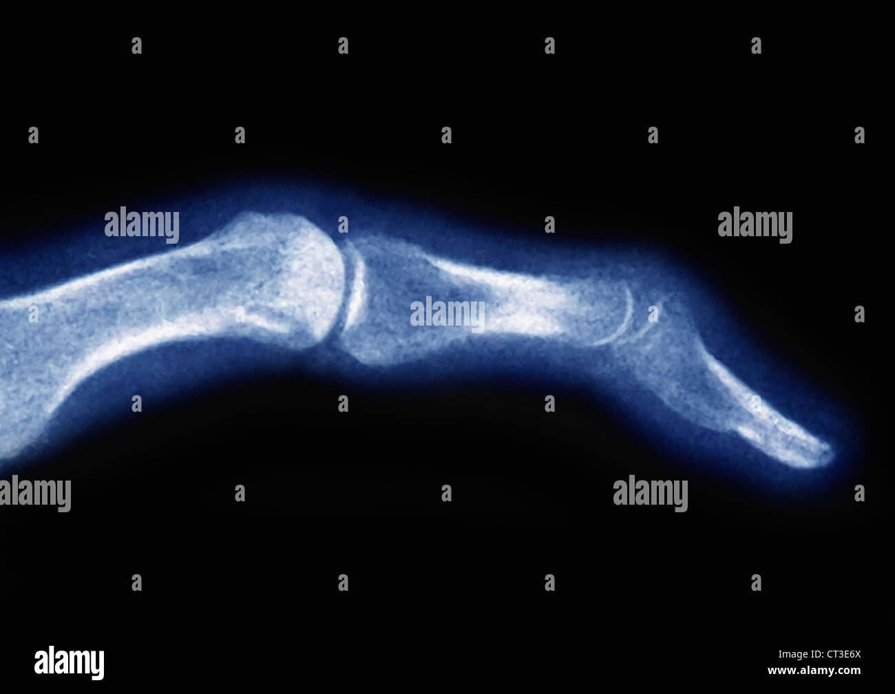 ARTHRITIS HAND, X-RAY Stock Photo