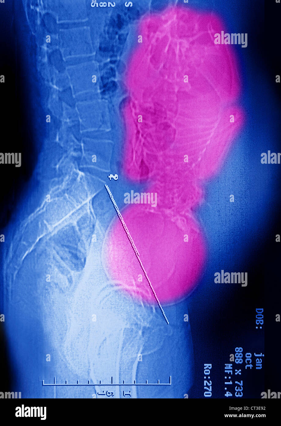 Pelvimetry exam hi-res stock photography and images - Alamy