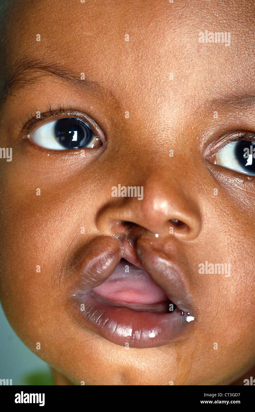 Africa African Baby Boy Cleft Cleft Lip Stock Photo