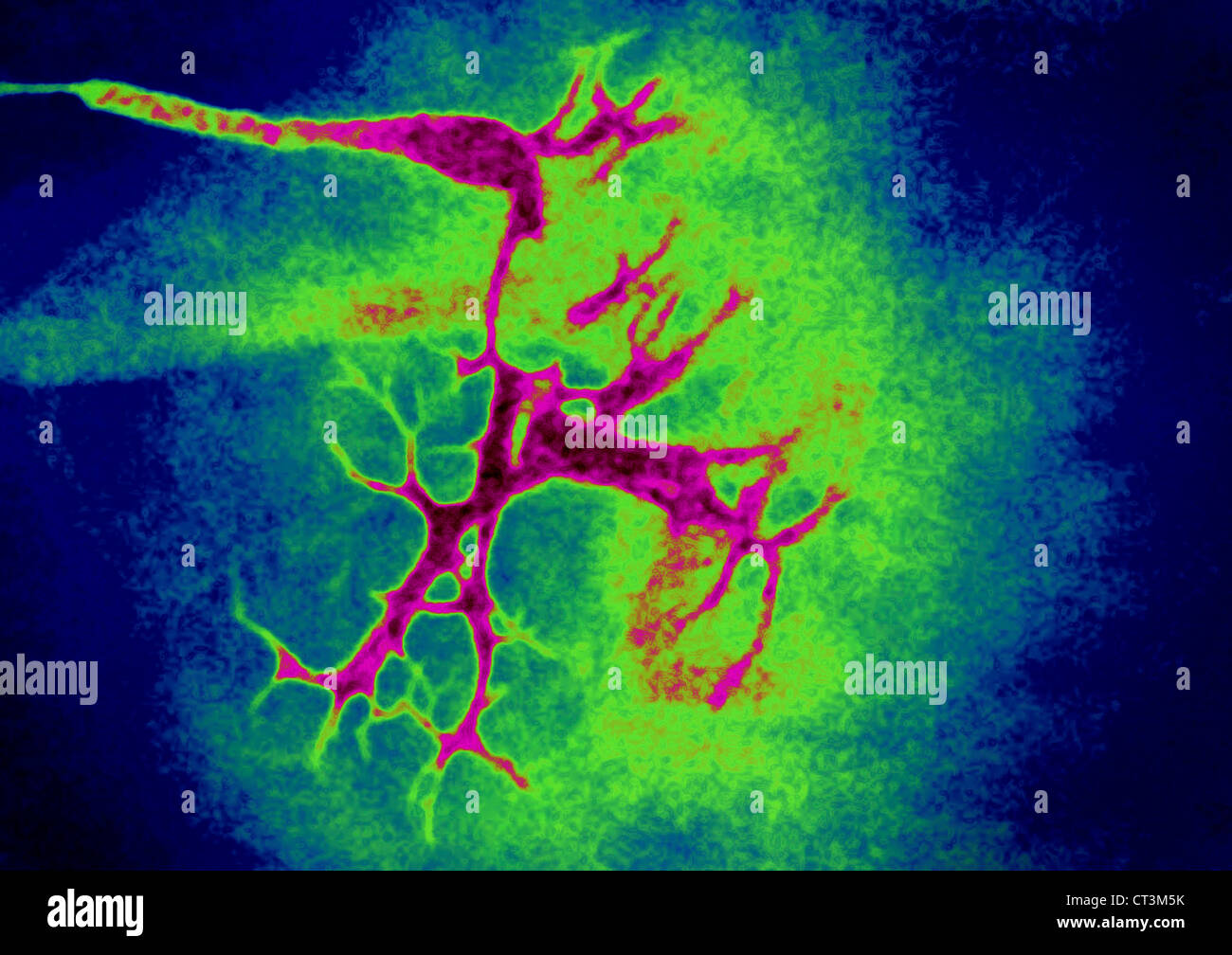 SALIVARY CALCULUS, XRAY Stock Photo Alamy