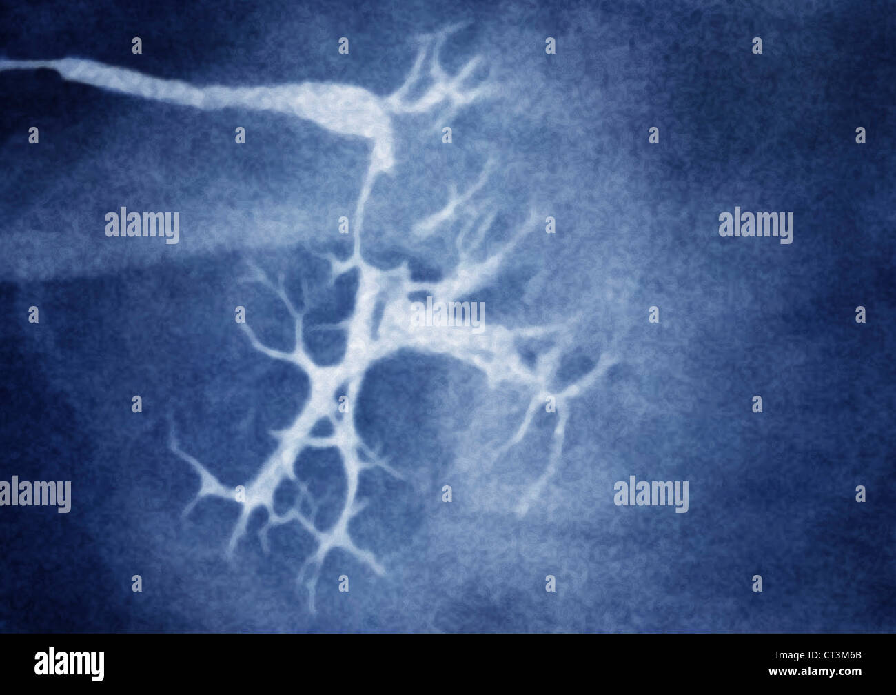 SALIVARY CALCULUS, XRAY Stock Photo Alamy