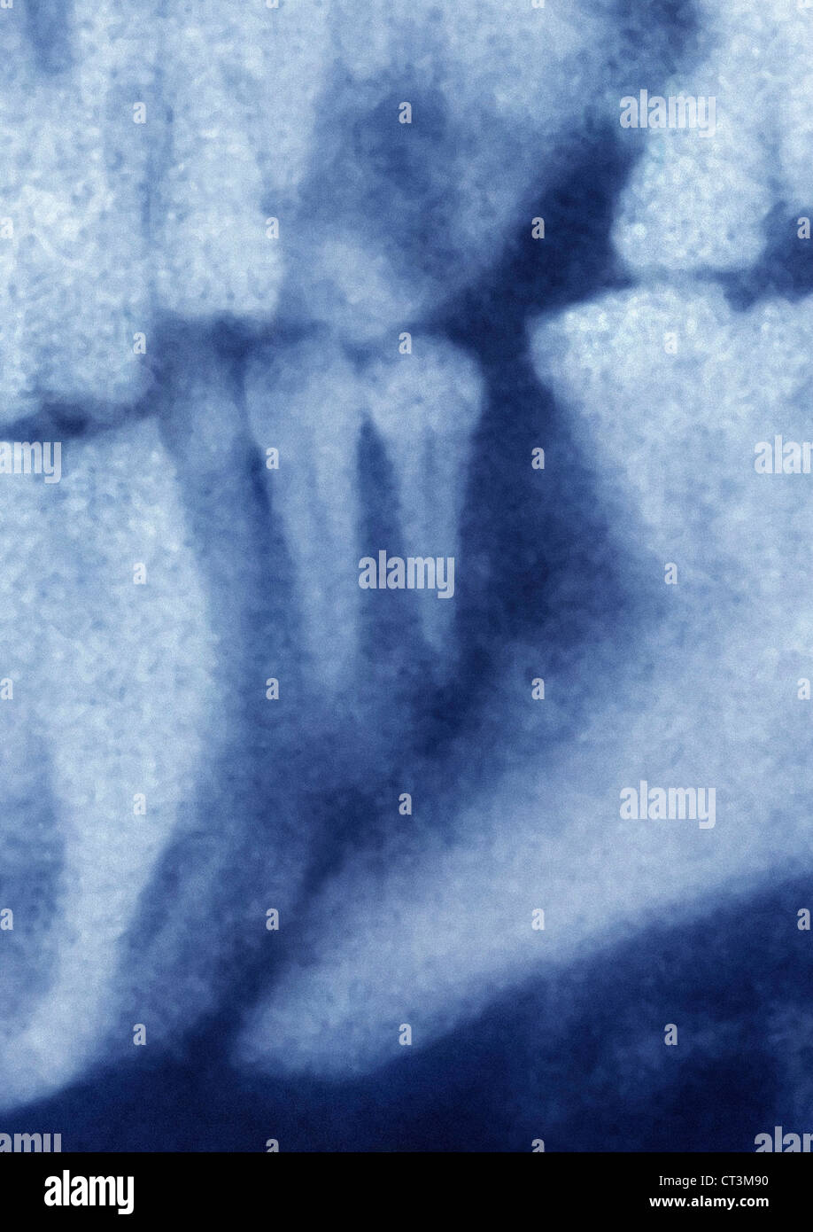 Maxillary Bones High Resolution Stock Photography and Images Alamy