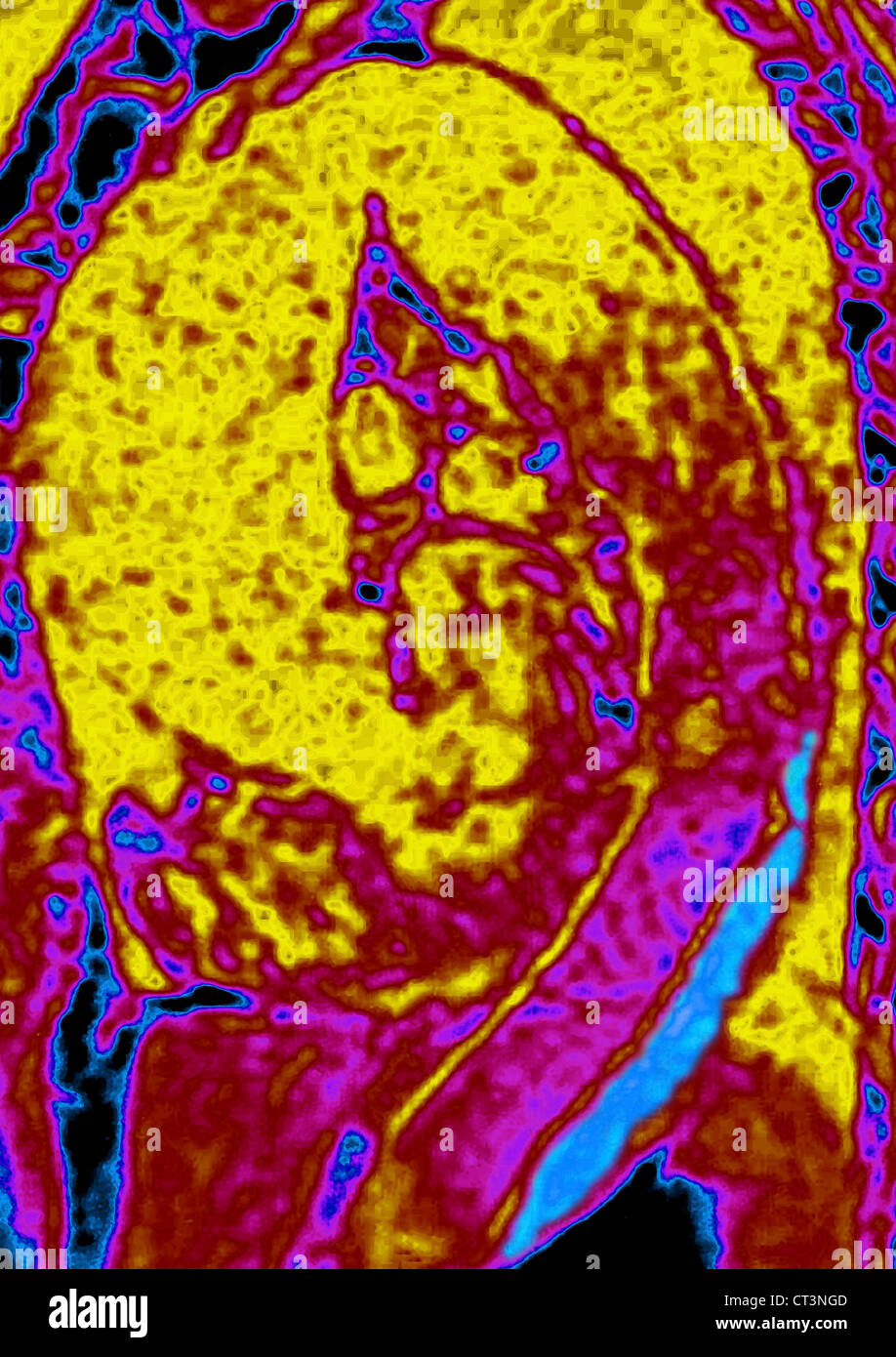 AORTIC DISSECTION, MRI Stock Photo