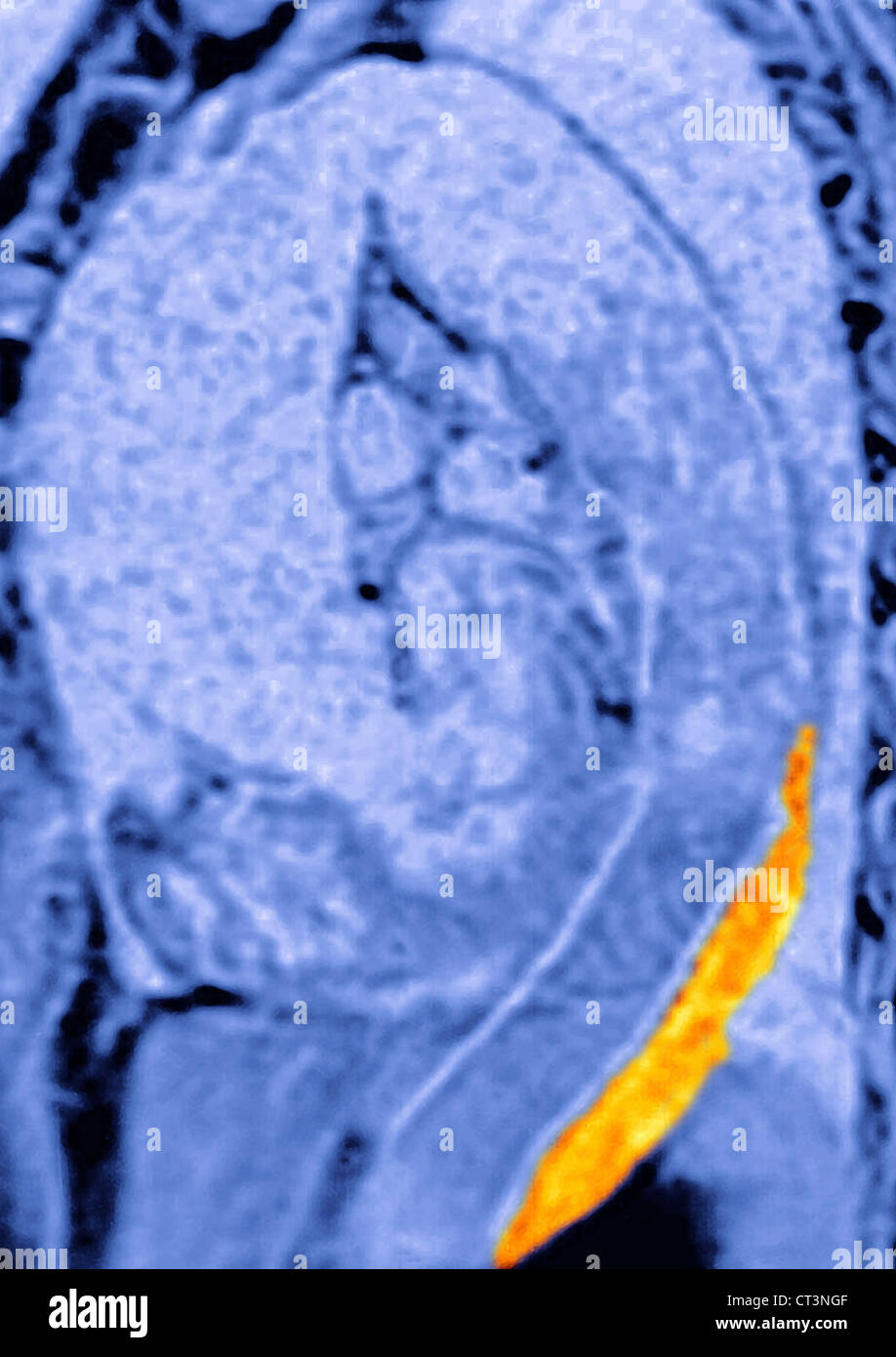 AORTIC DISSECTION, MRI Stock Photo