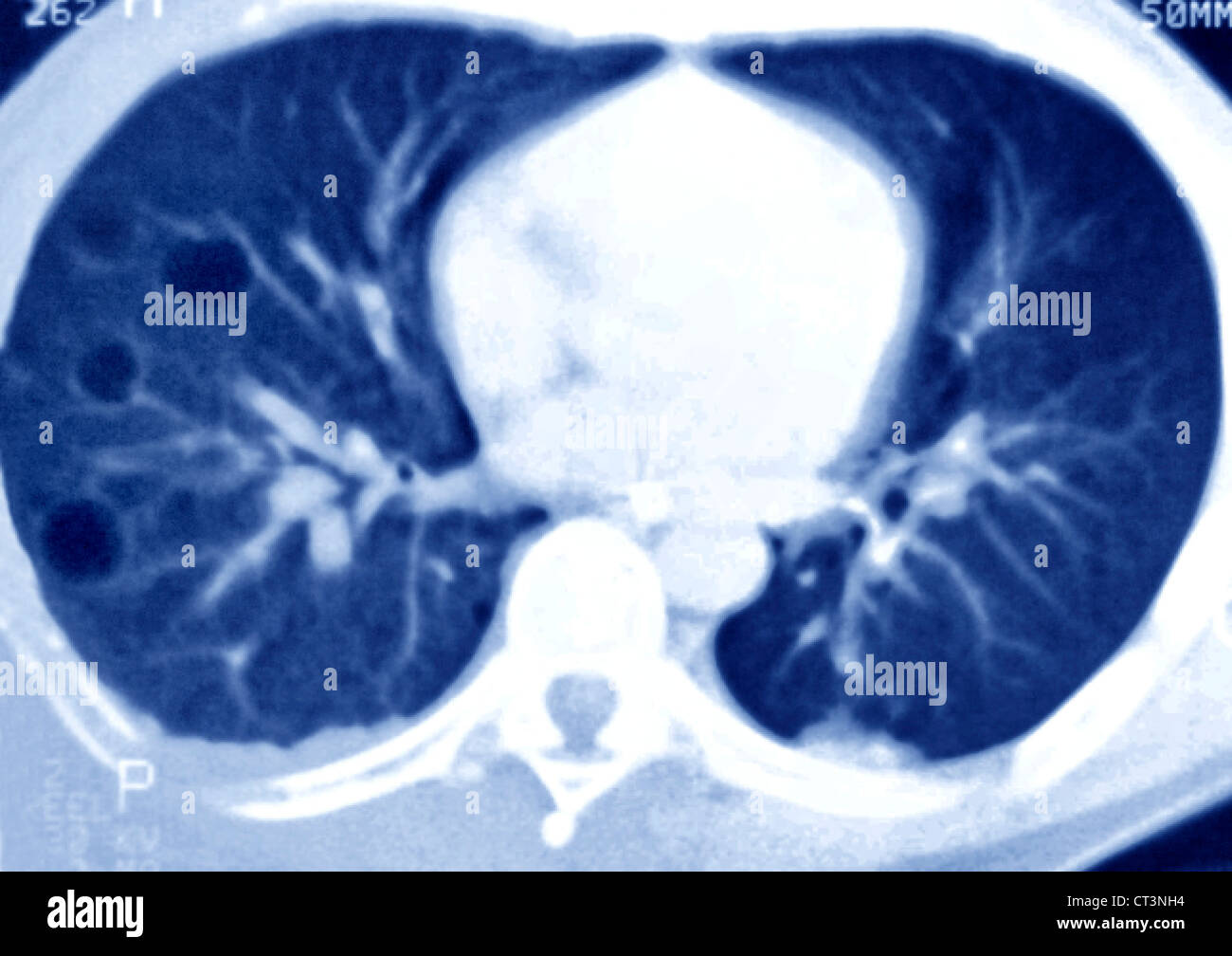 LUNG SCAN FOR EMPHYSEMA Stock Photo Alamy