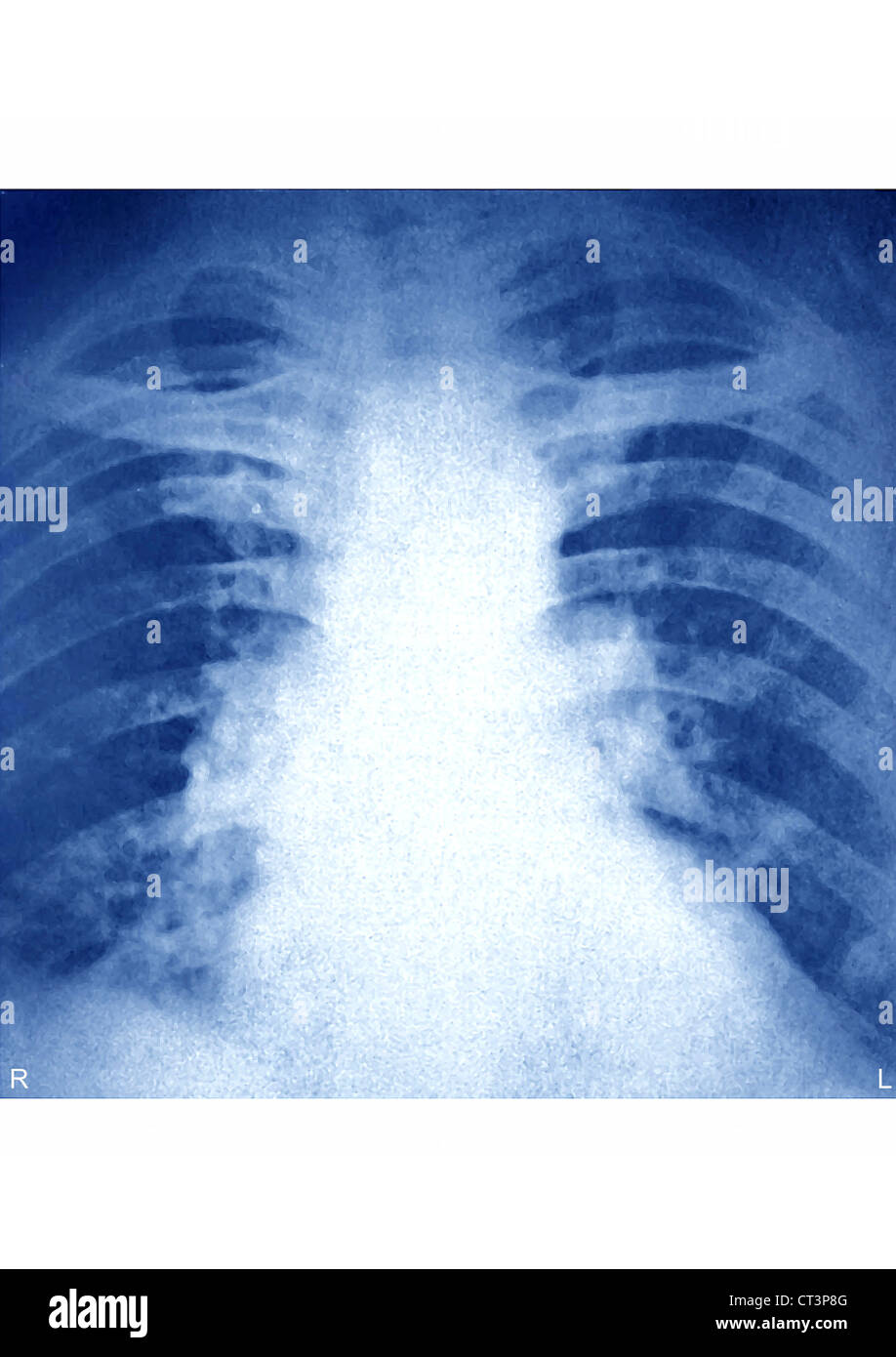 PULMONARY EMBOLISM, XRAY Stock Photo Alamy