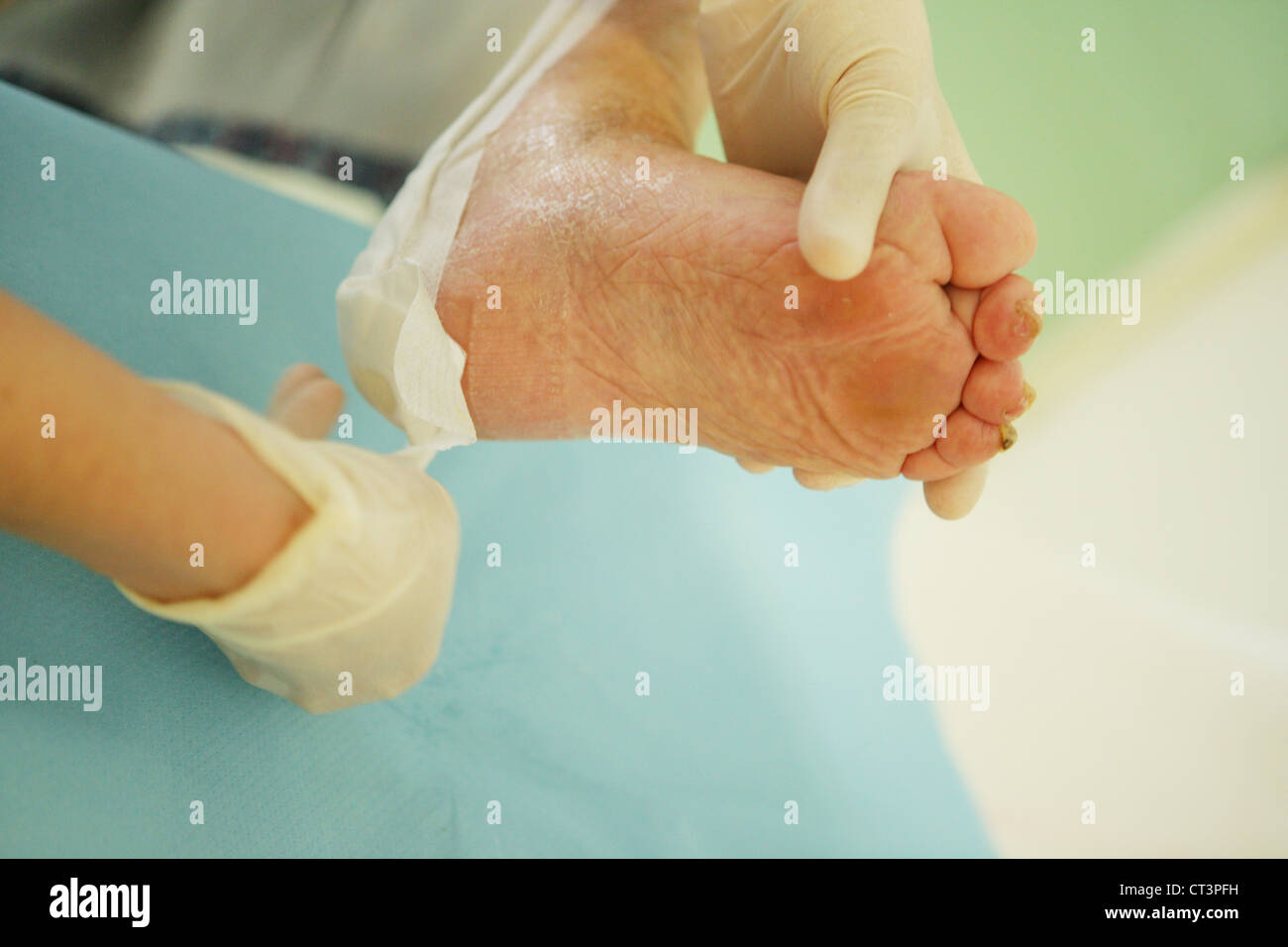 Decubitus ulcer treatment hires stock photography and images Alamy