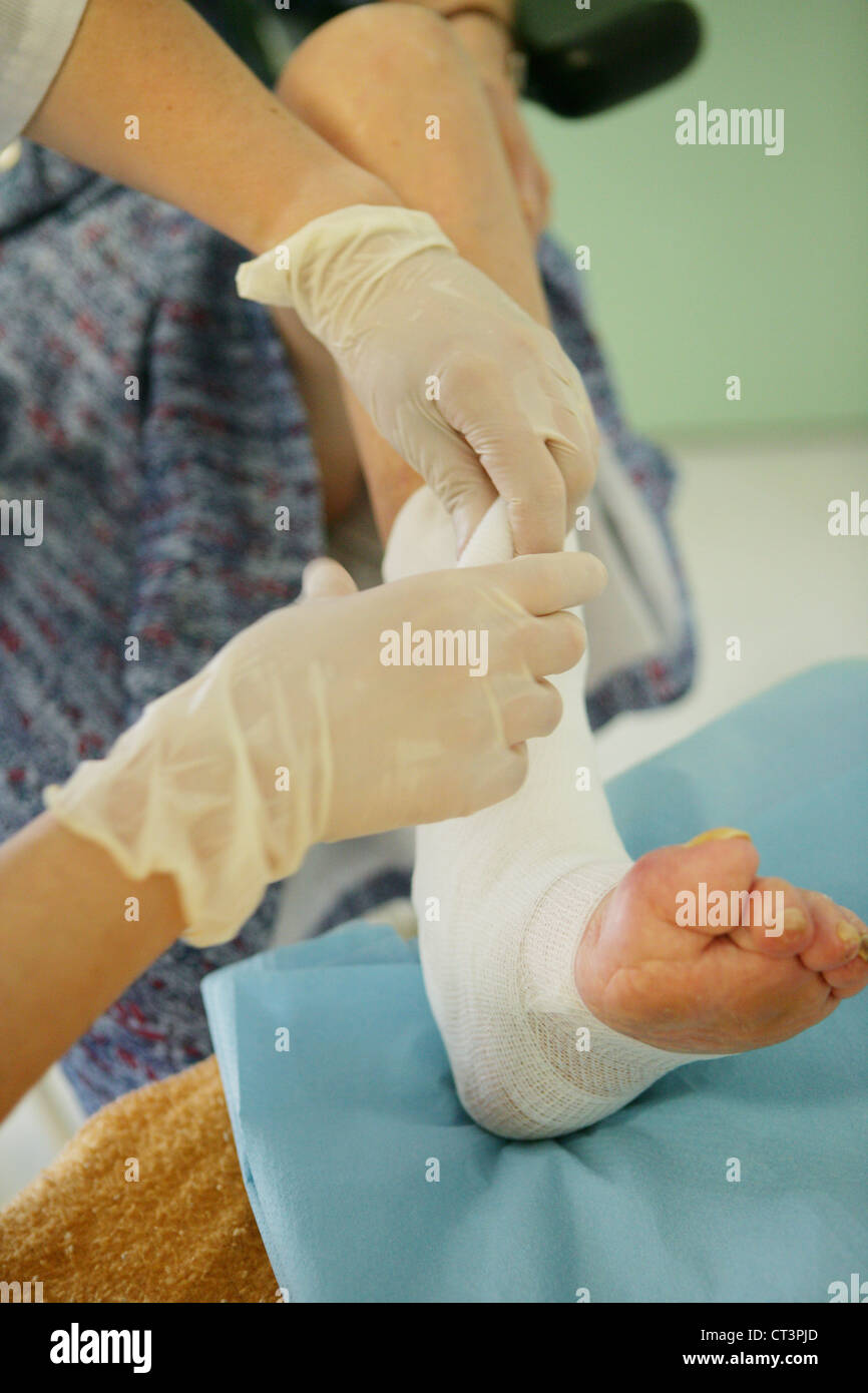 Decubitus ulcer treatment hires stock photography and images Alamy