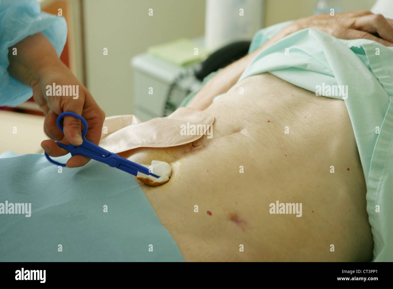 Stomin Insurence Colostomies hi-res stock photography and images - Alamy