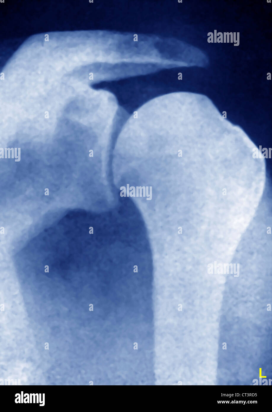 DISLOCATION SHOULDER, XRAY Stock Photo Alamy
