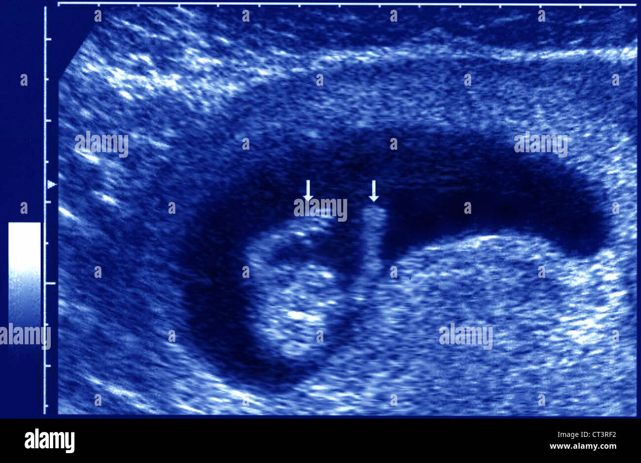 ULTRASOUND BIOMETRY OF THE FETUS Stock Photo - Alamy