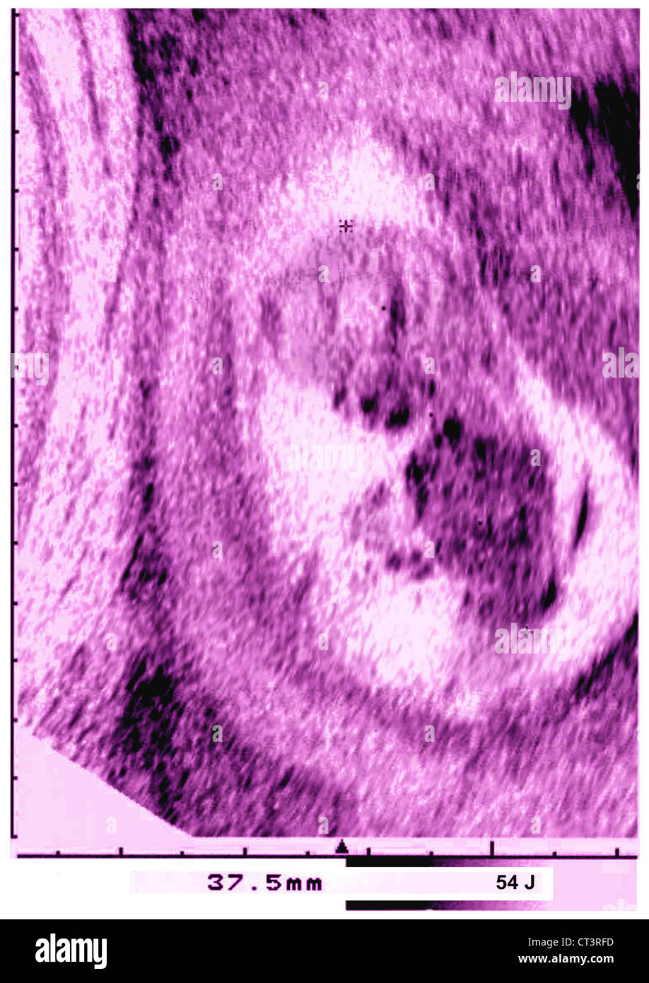 ULTRASOUND BIOMETRY OF THE FETUS Stock Photo Alamy