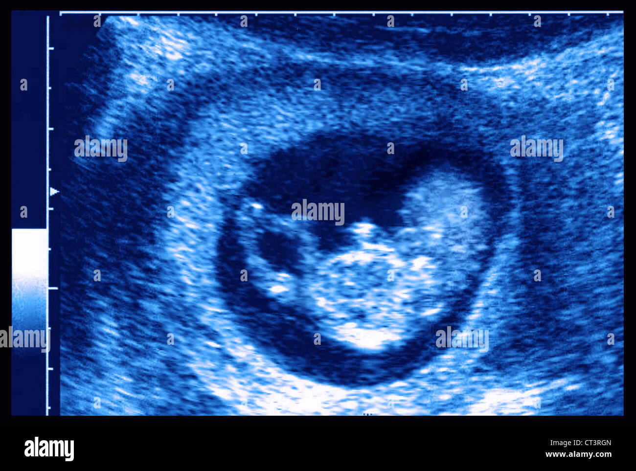 3 month fetus hi-res stock photography and images - Alamy
