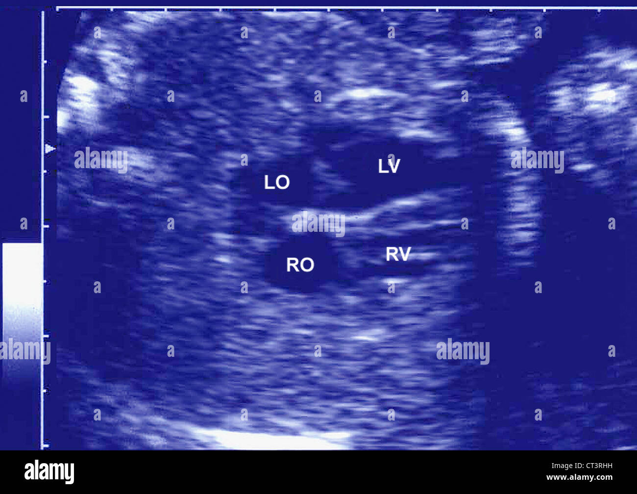 6 month fetus ultrasound hires stock photography and images Alamy