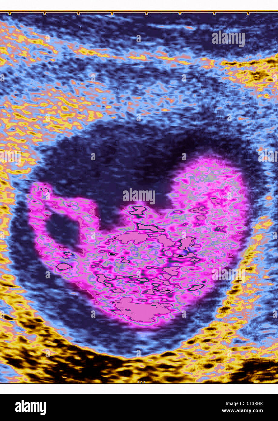 Ultrasound fetus 3 months hi-res stock photography and images - Alamy