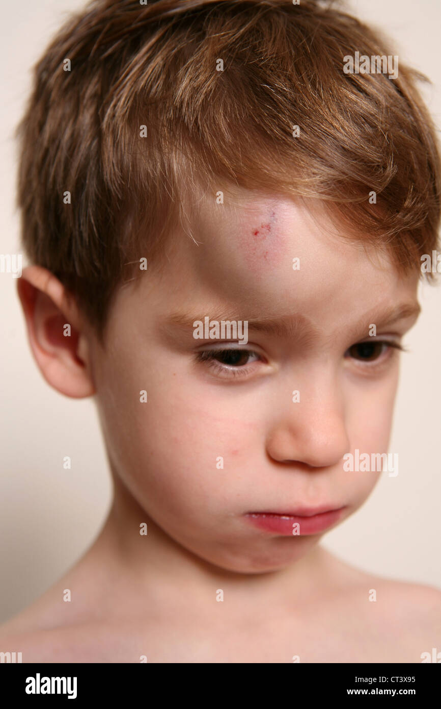 CHILD WITH HEMATOMA Stock Photo Alamy