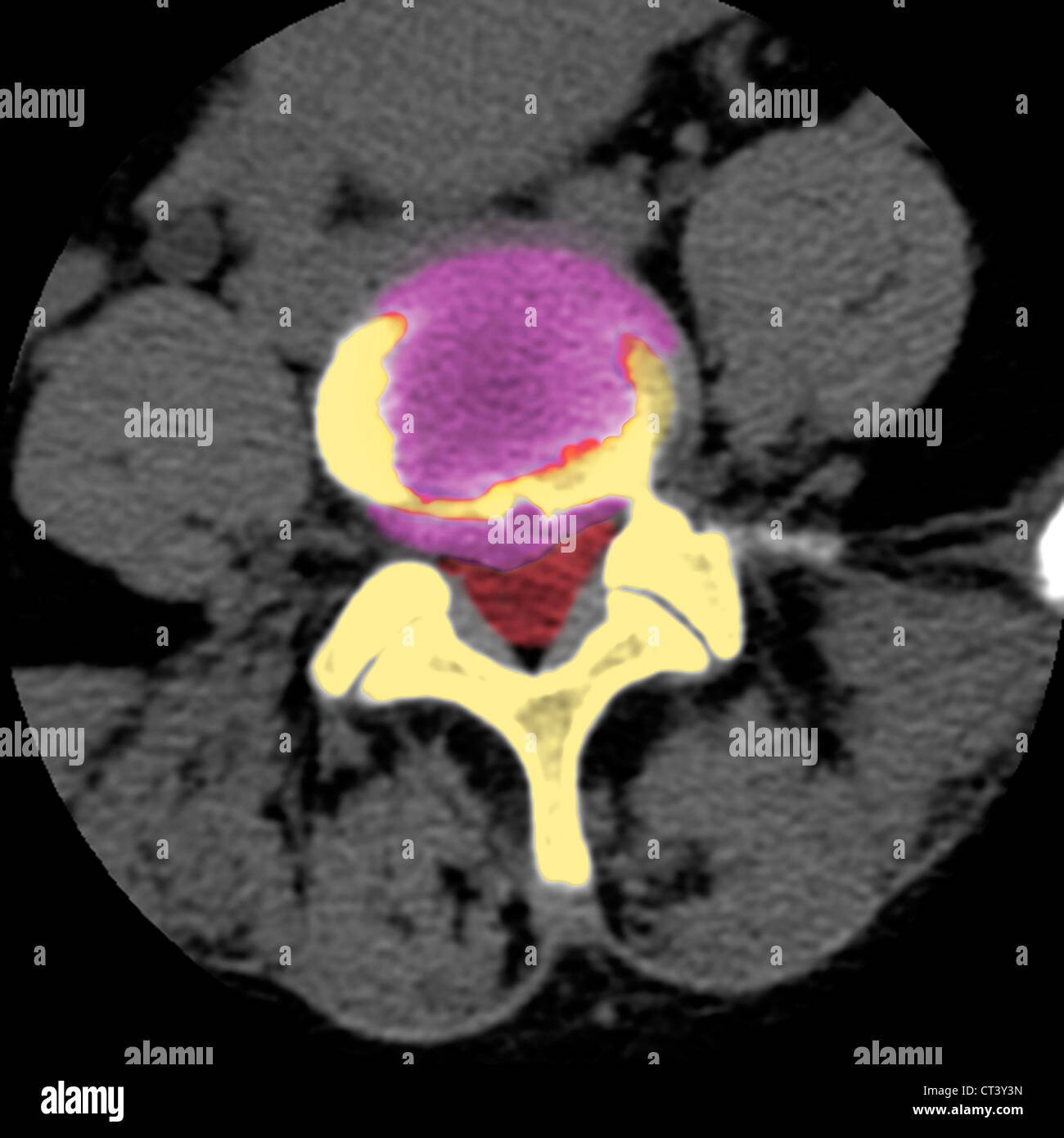 HERNIATED DISK, XRAY Stock Photo Alamy