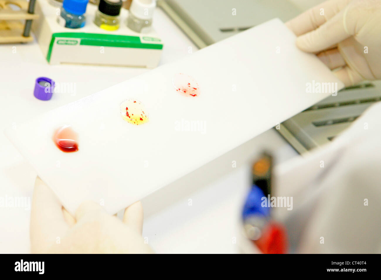Abo blood type testing hi-res stock photography and images - Alamy