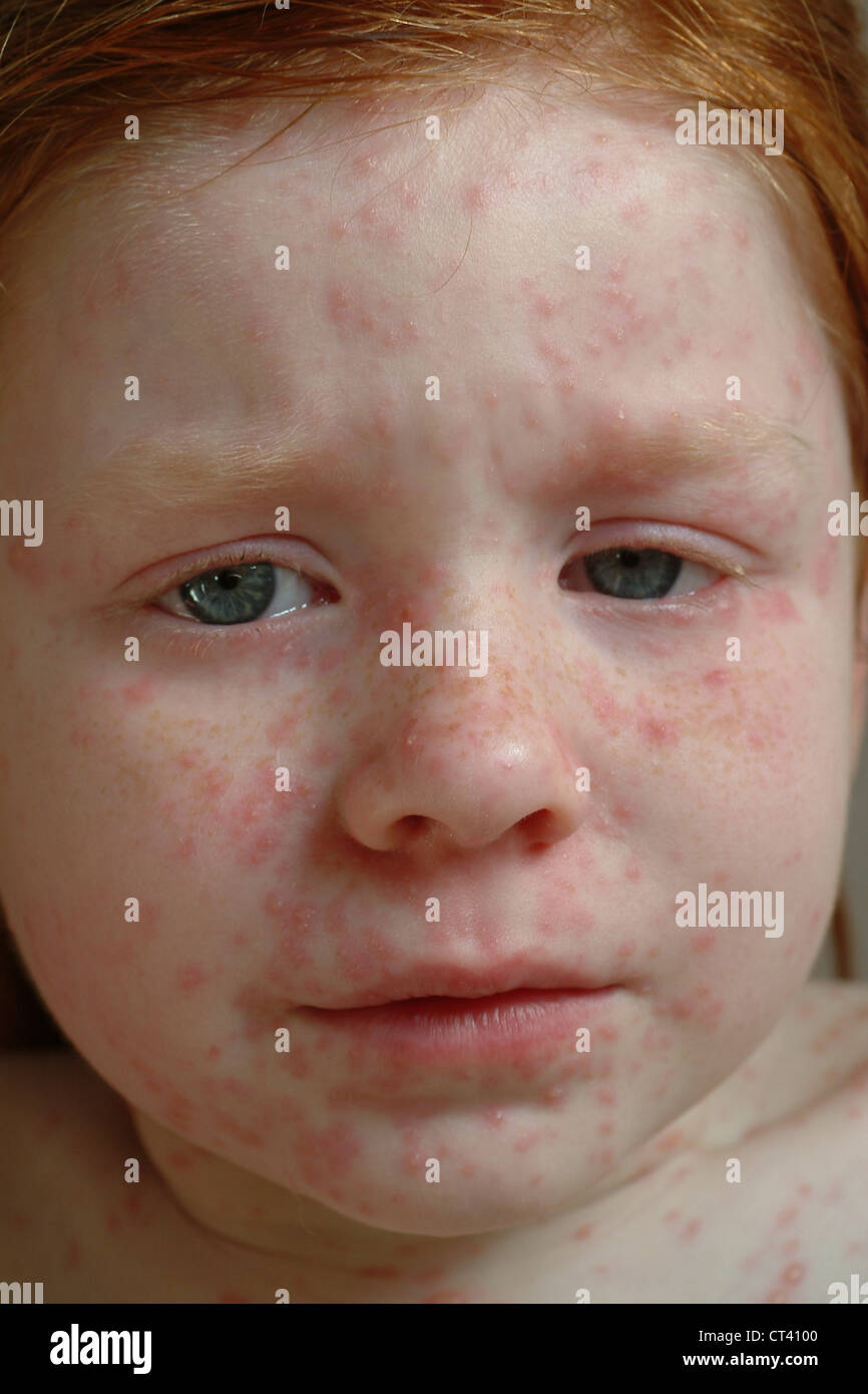 CHICKENPOX Stock Photo