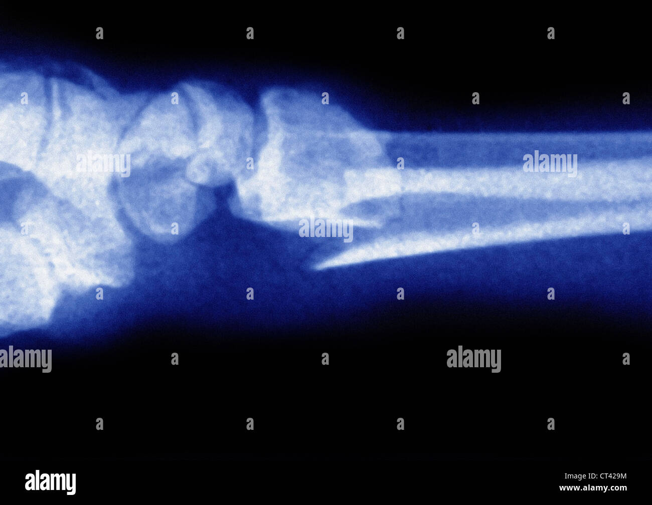 FRACTURED WRIST, XRAY Stock Photo Alamy