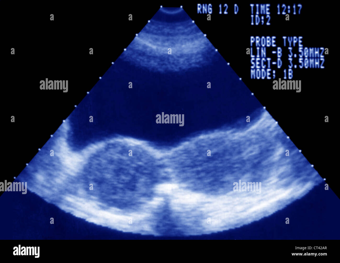 UTERUS, CYST Stock Photo Alamy