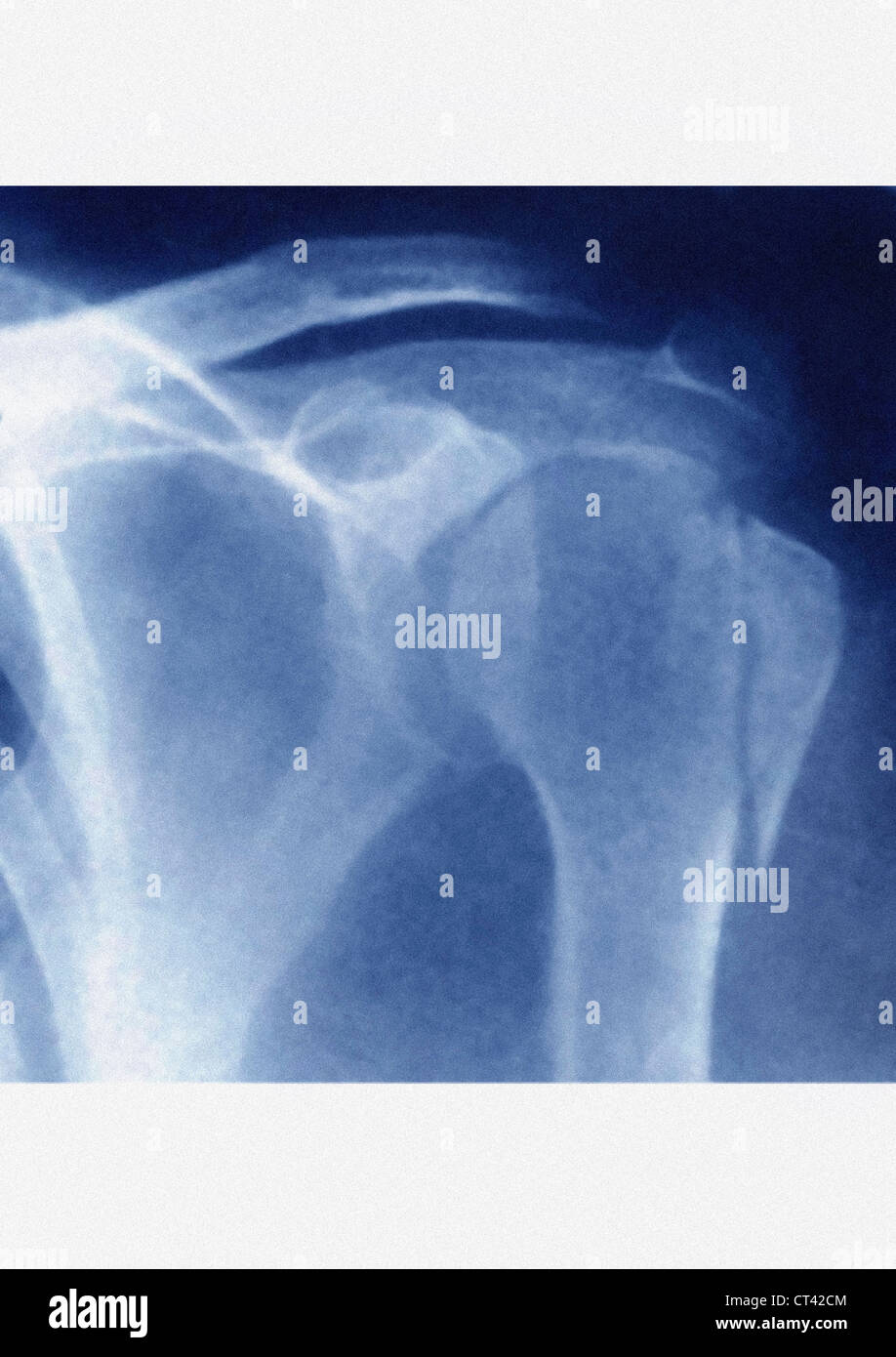 FRACTURED SHOULDER, XRAY Stock Photo Alamy